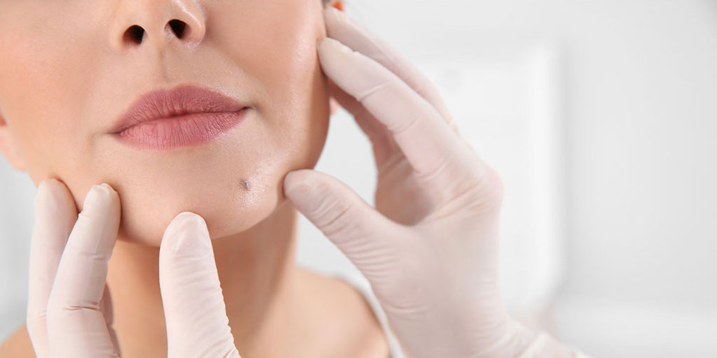 Benign Mole Removal